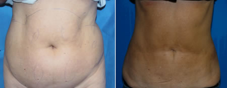 liposuction treatable areas